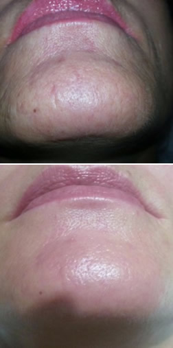 Radiofrekvenčni microneedeling